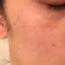 YAGレーザー 仁愛クリニック DAY 7 サムネイル用