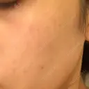 YAGレーザー 仁愛クリニック DAY 7 サムネイル用