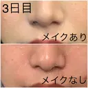 肌ヒアルロン酸注入（たるみ・シワ改善） / その他（肌） フィラークリニック 新宿院 AFTER サムネイル用