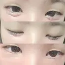 その他（目元） ばん皮膚科 DAY 1 サムネイル用