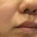 ほくろ・いぼ切除（肌） Mスキンクリニック AFTER サムネイル用