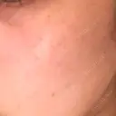 YAGレーザー 仁愛クリニック DAY 8 サムネイル用