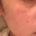 YAGレーザー 仁愛クリニック DAY 8 サムネイル用