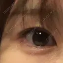 ヒアルロン酸注入（涙袋） the way（ザウェイ）整形外科 DAY 13 サムネイル用
