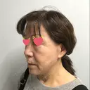 肌ヒアルロン酸注入（たるみ・シワ改善） ジョウクリニック 姫路院 DAY 56 サムネイル用