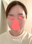 糸リフト / 骨切り（あご） / 骨削り（エラ） / 骨削り（頬） / 脂肪吸引（顔） RG整形外科（旧リオン整形外科） DAY 21 サムネイル用