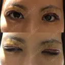 二重切開 / その他（目元） RG整形外科（旧リオン整形外科） DAY 0 サムネイル用