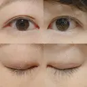 二重埋没 / 目頭切開 かめい美容クリニック宇都宮 DAY 467 サムネイル用