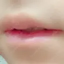 口唇縮小術 / PRP皮膚再生療法 品川美容外科 品川院 DAY 53 サムネイル用