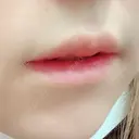 口唇縮小術 / PRP皮膚再生療法 品川美容外科 品川院 DAY 53 サムネイル用