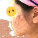 ピーリング（ニキビ・毛穴） / イオン導入 / エレクトロポレーション 湘南美容クリニック 宇都宮院 DAY 13 サムネイル用