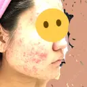 ピーリング（ニキビ・毛穴） / イオン導入 / エレクトロポレーション 湘南美容クリニック 宇都宮院 DAY 13 サムネイル用
