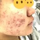 ピーリング（ニキビ・毛穴） / イオン導入 / エレクトロポレーション 湘南美容クリニック 宇都宮院 DAY 17 サムネイル用