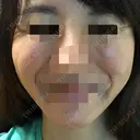 脂肪溶解注射（顔） ヴェリテクリニック 名古屋院 DAY 29 サムネイル用
