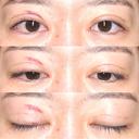 眼瞼下垂（切開） / その他（目元） / 目尻切開 / 自然癒着法 POP美容整形クリニック DAY 27 サムネイル用