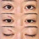 眼瞼下垂（切開） / その他（目元） / 目尻切開 / 自然癒着法 POP美容整形クリニック DAY 28 サムネイル用