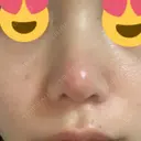 鼻尖形成（切開） / 鼻中隔延長（切開） / 小鼻縮小（切開） / 軟骨移植 HANABI整形外科 DAY 103 サムネイル用