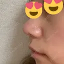 鼻尖形成（切開） / 鼻中隔延長（切開） / 小鼻縮小（切開） / 軟骨移植 HANABI整形外科 DAY 103 サムネイル用