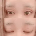 二重埋没 広島プルミエクリニック DAY 0 サムネイル用