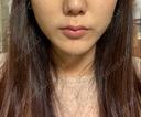 脂肪溶解注射（顔） 赤坂プレミアクリニック AFTER サムネイル用