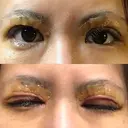 二重切開 / その他（目元） RG整形外科（旧リオン整形外科） DAY 5 サムネイル用