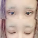 二重埋没 広島プルミエクリニック DAY 1 サムネイル用