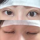二重埋没 / 目頭切開 アロマ美容外科クリニック DAY 0 サムネイル用