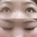 二重埋没 盛岡タウン形成外科クリニック DAY 46 サムネイル用