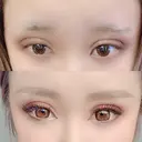 二重埋没 広島プルミエクリニック DAY 2 サムネイル用