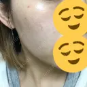 ニキビ治療 / 美肌レーザー / シミ取りレーザー UB CLINIC 銀座 DAY 28 サムネイル用