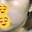 ニキビ治療 / 美肌レーザー / シミ取りレーザー UB CLINIC 銀座 DAY 28 サムネイル用