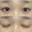 二重埋没 湘南美容クリニック 福島院 DAY 31 サムネイル用