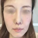 人中短縮 / 口角挙上 清潭女神美容外科 AFTER サムネイル用