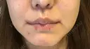 人中短縮 / 口角挙上 清潭女神美容外科 DAY 77 サムネイル用