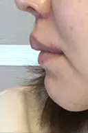 人中短縮 / 口角挙上 清潭女神美容外科 DAY 77 サムネイル用