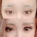 二重埋没 広島プルミエクリニック DAY 3 サムネイル用