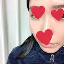 骨削り（頬） / 輪郭修正 マックスファクス銀座クリニック AFTER サムネイル用