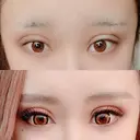 二重埋没 広島プルミエクリニック DAY 4 サムネイル用