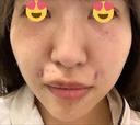 PRP皮膚再生療法 聖心美容クリニック 名古屋院 AFTER サムネイル用