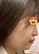 PRP皮膚再生療法 聖心美容クリニック 名古屋院 DAY 1 サムネイル用