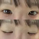 その他（目元） ばん皮膚科 DAY 14 サムネイル用