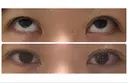 二重切開 / 上まぶたたるみ取り / 上まぶたの脂肪取り / 目元修正 リビジョンクリニック（旧：池本形成外科・美容外科） DAY 40 サムネイル用