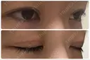 二重切開 / 上まぶたたるみ取り / 上まぶたの脂肪取り / 目元修正 リビジョンクリニック（旧：池本形成外科・美容外科） DAY 40 サムネイル用