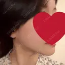 骨切り（あご） / 骨削り（エラ） / 脂肪注入（輪郭） RG整形外科（旧リオン整形外科） DAY 96 サムネイル用