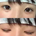 その他（目元） ばん皮膚科 DAY 15 サムネイル用