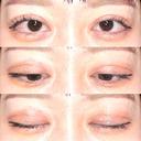 眼瞼下垂（切開） / その他（目元） / 目尻切開 / 自然癒着法 POP美容整形クリニック DAY 36 サムネイル用