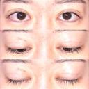 眼瞼下垂（切開） / その他（目元） / 目尻切開 / 自然癒着法 POP美容整形クリニック DAY 36 サムネイル用