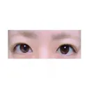 二重埋没 湘南美容クリニック 長野院 AFTER サムネイル用
