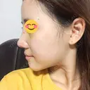 隆鼻術 / 鼻尖形成（切開） / 鼻中隔延長（切開） / 鼻孔縁挙上 ソウルリスタ整形外科 DAY 6 サムネイル用