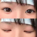 その他（目元） ばん皮膚科 AFTER サムネイル用